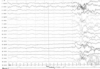 EEG of the pediatric patients, problems in the electrical activity of the brain.Abnormal EEG.