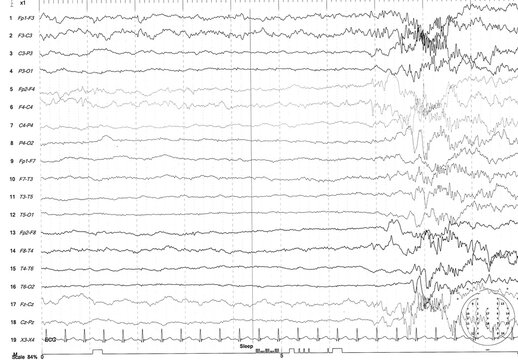 EEG of the pediatric patients, problems in the electrical activity of the brain.Abnormal EEG.