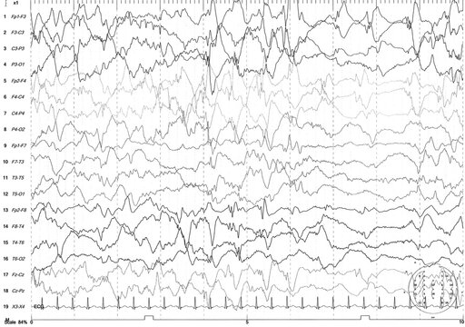 EEG of the pediatric patients, problems in the electrical activity of the brain.Abnormal EEG.