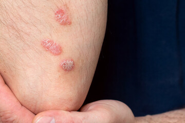 Fototapeta premium Psoriasis on the elbow. A man shows a focus of psoriasis on his body