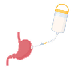 胃ろうに栄養剤を投与するイラスト_胃の断面_PEG
