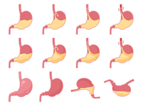51 Best 逆流性食道炎 Images Stock Photos Vectors Adobe Stock 51 Best 逆流性食道炎 Images Stock Photos Vectors Adobe Stock