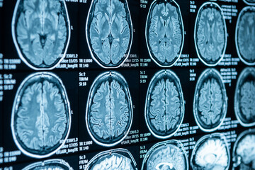 MRI, computed tomography of the spine. Checking back sections in the hospital.