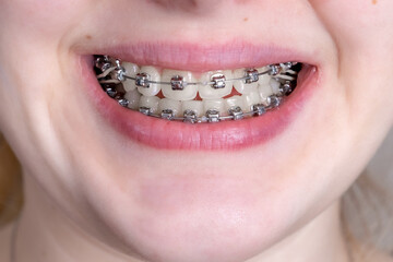 Obraz premium Metal orthodontic braces on crooked teeth close-up.