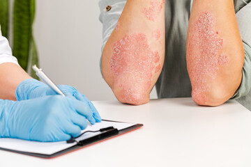 A gloved dermatologist examines the skin of a sick patient and records observations. Examination and diagnosis of skin diseases-allergies, psoriasis, eczema, dermatitis