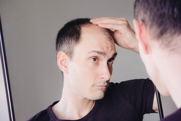 Fototapeta premium Male pattern hair loss problem concept. Young caucasian man looking at mirror worried about balding. Baldness, alopecia in males.