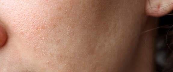 Female face with problem skin. Peeling during cold weather, acne and rashes. Problem skin of the face.