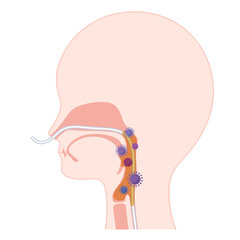 経鼻経管栄養_NGで痰と細菌が増加した咽頭のイラスト
