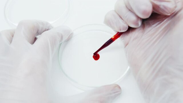 Close-up of doctor's hand in protective gloves doing blood test in petri dish. Vaccine against virus. Blood test for antibodies, Rh factor, infection. Determination of blood group. Drop of blood.