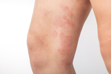Severe atopic eczema on the legs of a child is a dermatological disease of the skin. Large, red, inflamed, scaly rash on the legs. Legs of a teenager with severe atopic dermatitis.Close-up