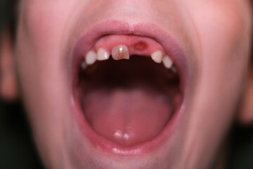 Little baby toothless kid mouth,children health teeth care,dentistry