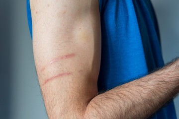 Man's athlete arm with two long healing scars from scratches. Wounds on the skin caused by sport activity. Healthcare and sport concept