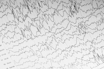 EEG wave form of the pediatric patients, problems in the electrical activity of the brain.Abnormal...