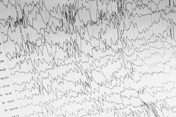 EEG wave form of the pediatric patients, problems in the electrical activity of the brain.Abnormal...