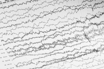 EEG wave form of the pediatric patients, problems in the electrical activity of the brain.Abnormal...