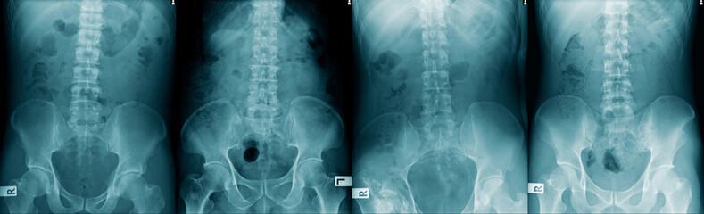 collection spine and pelvic bone