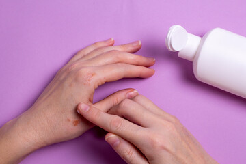 Women's hands with eczema apply the cream to the damaged skin of the hands. Treatment of dermatitis and eczema. Problems with the skin of the hands.