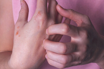 Close-up of a woman's hands itching. dermatitis or eczema on the hands. Allergic skin with red spots.