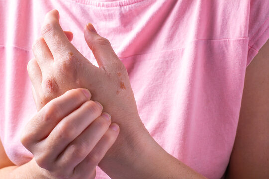 Close-up of a woman's hands itching. dermatitis or eczema on the hands. Allergic skin with red spots.