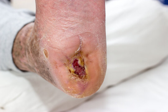 Ulcus - ulcer