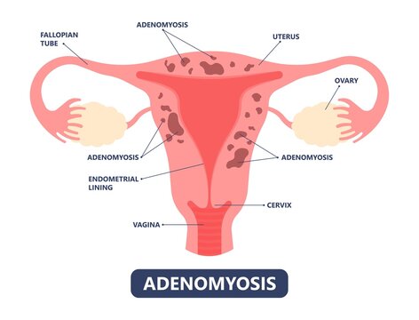 Adenomyosis pain cancer heavy disease disorder uterine surgery tissue cycle enlarged bigger abdomen female menses profuse polyp medical reproduction