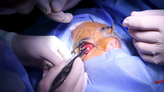 Surgery team making strabismus surgery to young girl