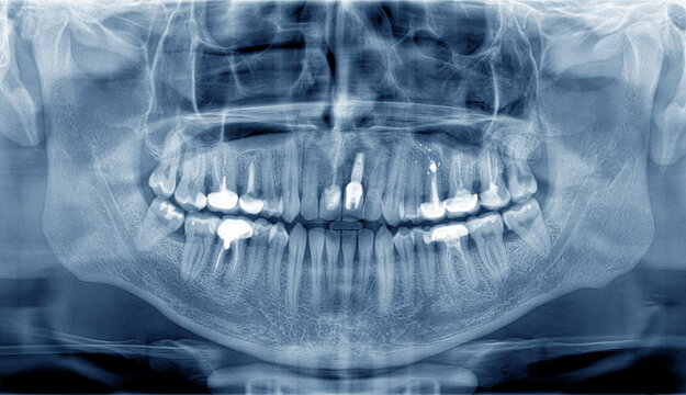 Blue panoramic dental X-Ray of teeth