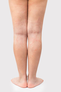 Legs of a teenager with severe atopic eczema. Acute atopic dermatitis on the legs of a child is a dermatological disease of the skin. Large, red, inflamed, scaly rash on the legs.