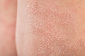 Close-up severe atopic eczema on the legs behind the knees of a child is a dermatological disease...
