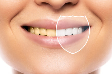 Teeth whitening and hygiene. Result after treatment in professional dental clinic.