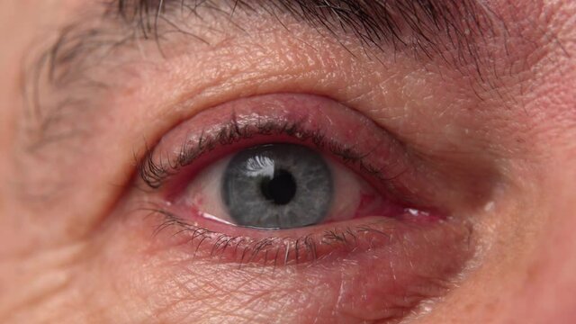 A red tired eye of an elderly man with wrinkles around a close-up.