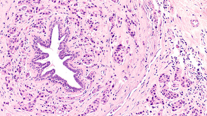 Histology of breast cancer, with a large benign mammary duct surrounded by an infiltrating (invasive) ductal carcinoma.