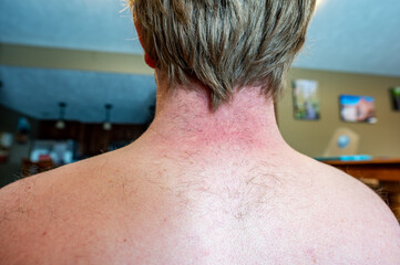 Middle aged white male with patchy back hair