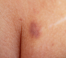 hematoma on the skin as a background