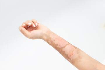 Thermal burn on the hand, skin peeling - obrazy, fototapety, plakaty