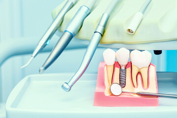 Implantology concept. Dental implants with mirror in dental clinic