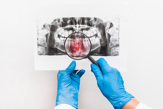 A doctor in protective medical gloves holds an X-ray picture of teeth in her hands and examines it through a magnifying glass on a white background