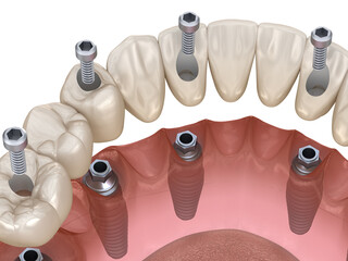 Mandibular prosthesis All on 4 system supported by implants, screw fixation. Medically accurate 3D illustration of dental concept