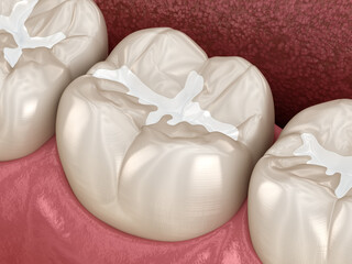 Fototapeta na wymiar Molar Fissure dental fillings, Medically accurate 3D illustration of dental concept