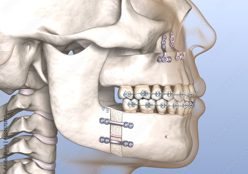 Wall mural Maxillomandibular Advancement surgery. Medically accurate dental 3D illustration.