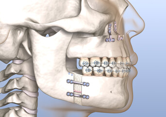 Maxillomandibular Advancement surgery. Medically accurate dental 3D illustration.