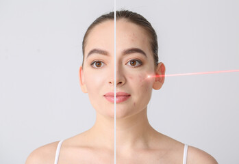 Young woman before and after procedure of acne removal by laser on light background - obrazy, fototapety, plakaty