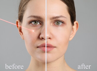 Face of young woman before and after treatment by laser on grey background