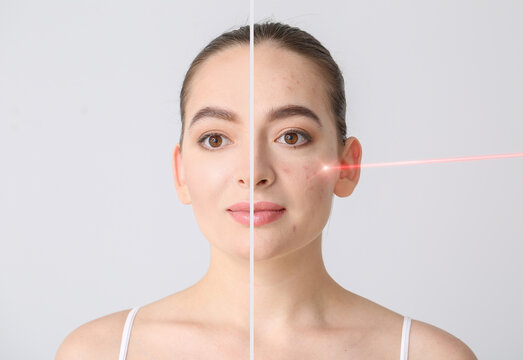 Young woman before and after procedure of acne removal by laser on light background