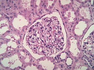 Kidney biopsy showing a normal glomerulus composed of thin capillaries. The surrounding tissue is...