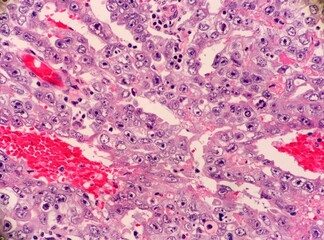 Malignant testicular cancer called embryonal carcinoma.  This is a type of germ cell tumor. Notice...