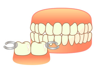 Denture Illustration Set: Denture Illustration