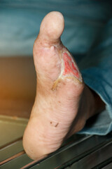 Infected wound of diabetic foot and amputation