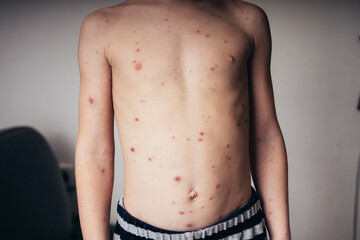 chickenpox in a child, rash. selective focus