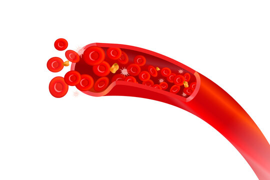 Healthy Arteries With Red Erythrocytes, High Cholesterol Concept Illustration On White